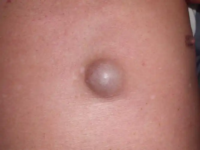 腋窝下皮脂腺囊肿图片