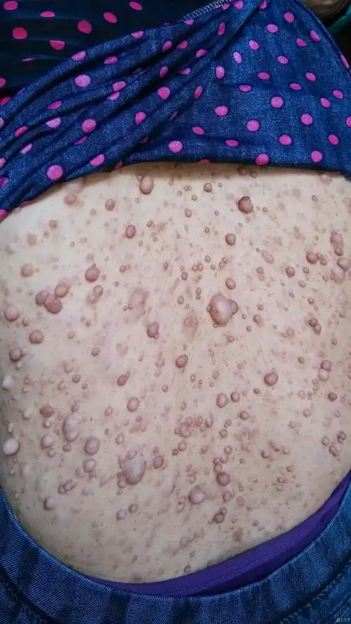 该患者是神经纤维瘤吗? - 皮肤及性传播疾病讨论版 - 爱爱医医学论坛