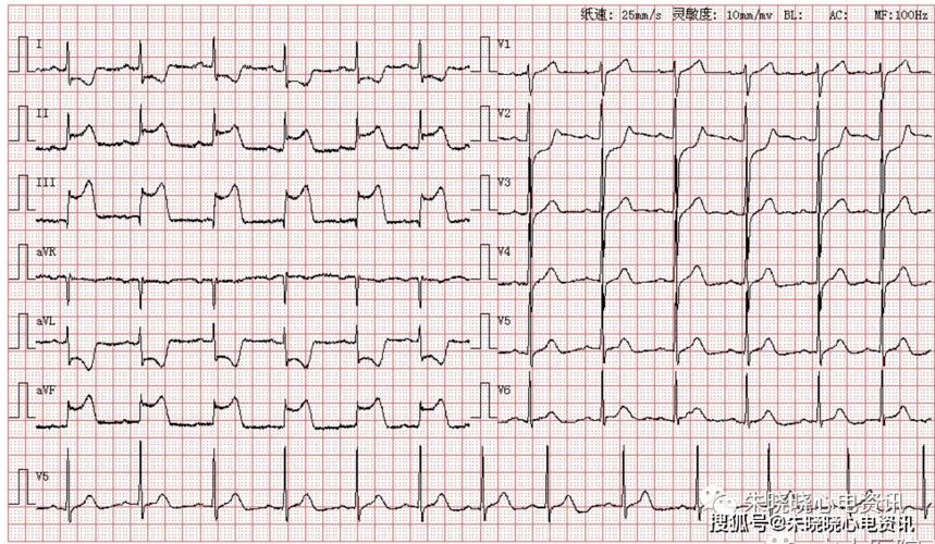 每日读图 || 第1078期 下壁心肌梗死_avr