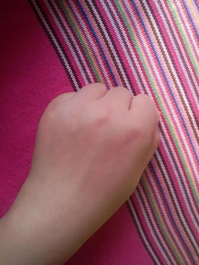 在湖南长沙,10岁女孩婷婷因为玩"起泡胶",双手起了