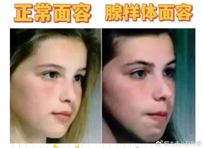 儿童腺样体肥大,为什么很多家长浑然不知,该不该手术治疗?