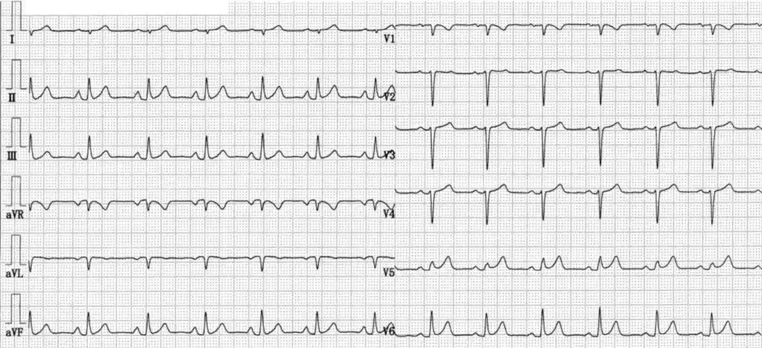 心电图出现st段抬高竟然是因为ta温故知心
