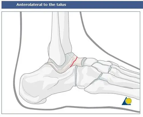 距骨骨折手术入路---前外侧入路