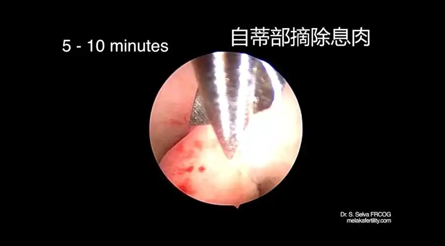 妇科宫腔镜手术