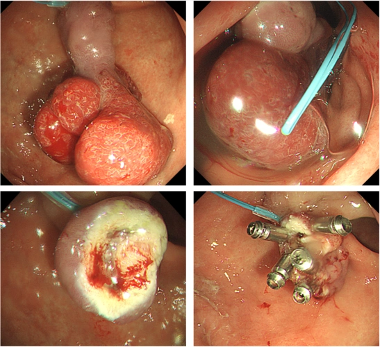 这样的胃息肉你见过吗
