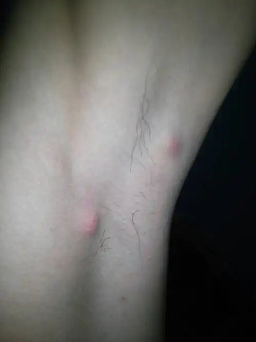 问:腋下长两个红色的硬块,也就是小疙瘩,大概半厘米直径,捏起来疼疼的