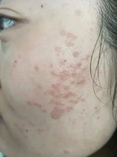 有和我一样脸上长扁平疣的吗?有什么好办法相互告知一下?