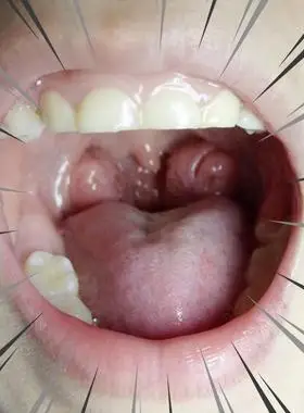 腺样体肥大中药贴面容矫正器儿童宝宝睡觉张嘴呼吸鼻塞打呼通气贴