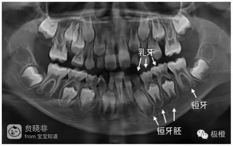 > 帖子详情  (没想到宝宝的牙齿在x光下是这样的吧:)  误区三:乳牙不