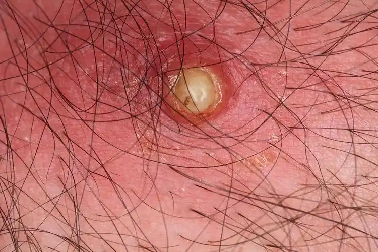 皮肤出现小眼,结痂,一挤挤出虫子!_蛆虫