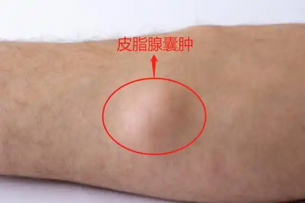 手臂粉瘤早期图片