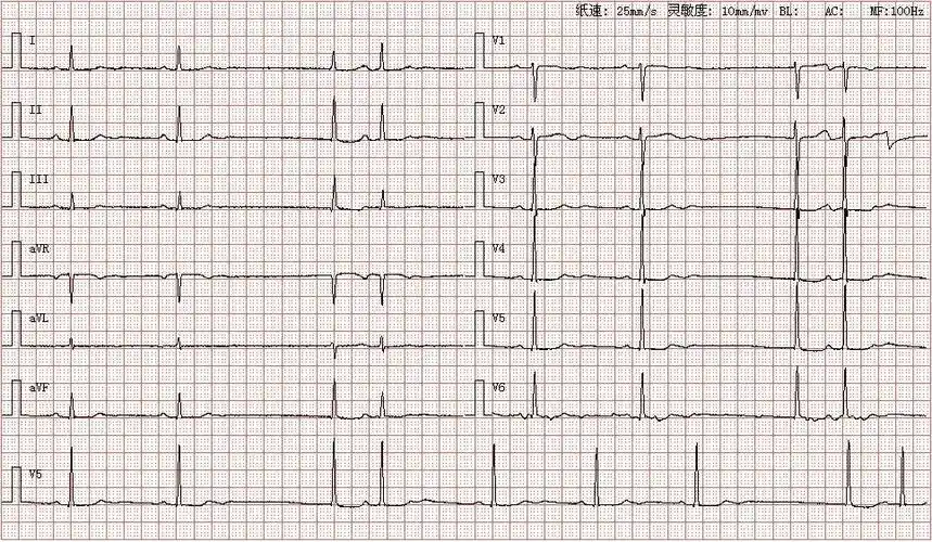 心电图图库丨二度ii型窦房传导阻滞系列