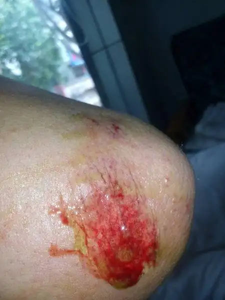 今天骑电动车转弯摔倒擦到皮, 吃什么药,饮食上注意什么,快高考了