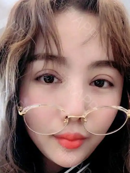 做完双眼皮10天了,不得不说恢复的真的好快,看着眼睛一天比一天好看