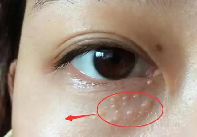 脂肪粒可以用激光去除吗眼角的脂肪粒可以用激光去除吗