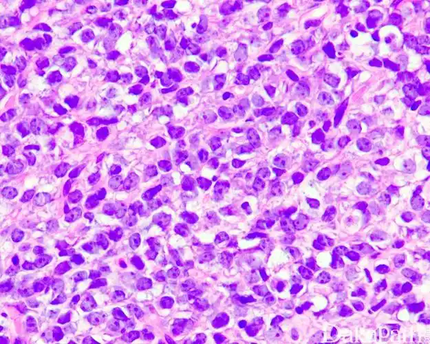 黏液样脂肪肉瘤