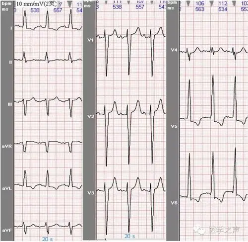 图30b 不完全性左束支传导阻滞