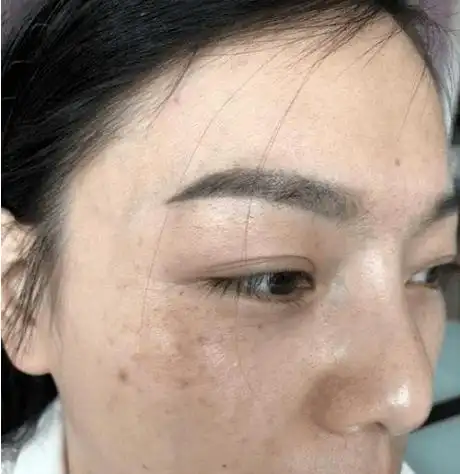 42岁大姐脸上黑色素多坚持喝蜂蜜水美白怎样了听听医生建议