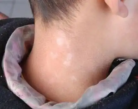 1岁宝宝脸上有白斑能用药吗