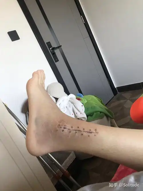 崴一脚骨折的可能性大么?