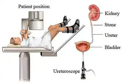 膀胱镜检查_尿路感染_尿路感染检查 - 好大夫在线