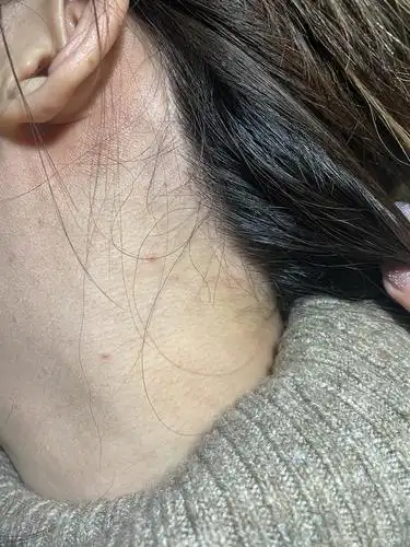 脖子上有了一些小疙瘩,被美容院说是扁平疣