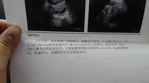 八周比超孕囊3.3*1.6*6.0cm正常吗