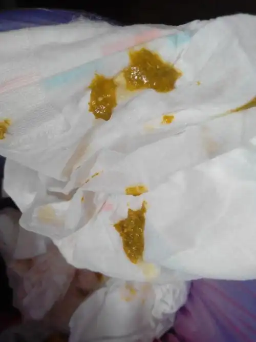 拉肚子,这样的大便正常吗