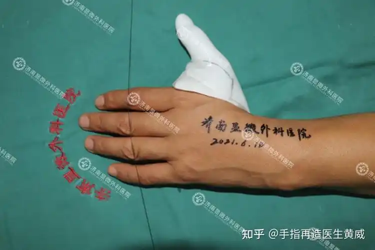 我院成功为先天性拇指缺损合并第一掌骨缺损患者实现手指再造 - 知乎