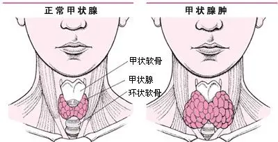正确认识甲状腺癌