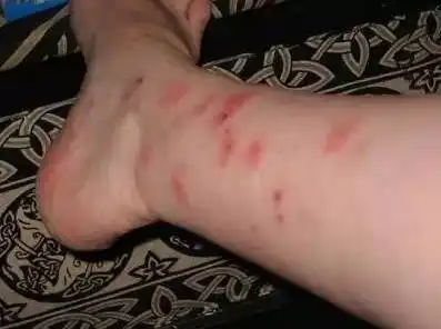 温哥华床虱又回来了!坐公交也能感染,99%的人不知道自己家也有!