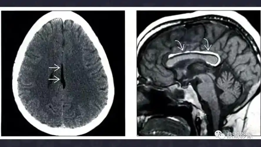 颅内脂肪瘤影像诊断及鉴别诊断