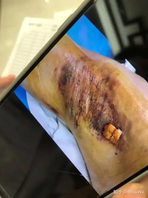 经历告诉你腋下狐臭手术千万不要做