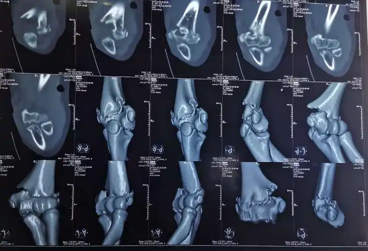 儿童肱骨髁上骨折(屈曲型)