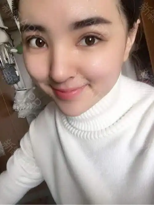 双眼皮一个月恢复的挺好的