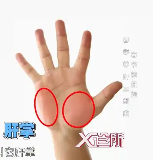 大拇指和小指根部的大小鱼际处出现片状出血的现象,就是所谓的"肝掌"