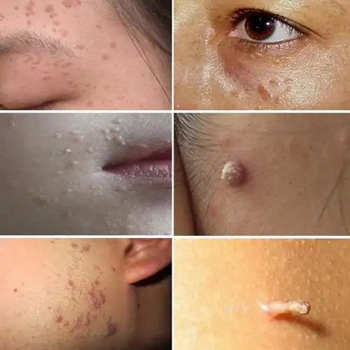 寻常疣的种类及图片