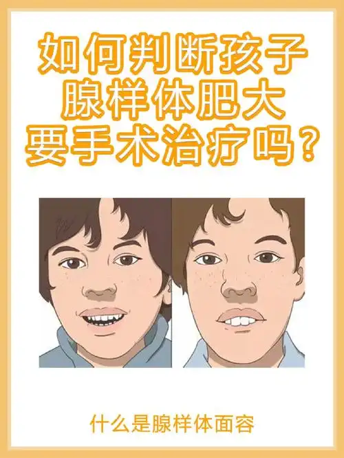 如何判断孩子腺样体肥大需要手术治疗吗