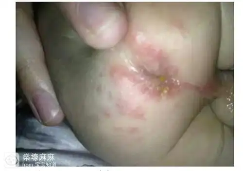 【夏日大作战】夏天尿布疹,痱子护理_百度宝宝知道