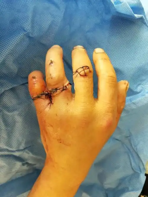 环小指离断再植