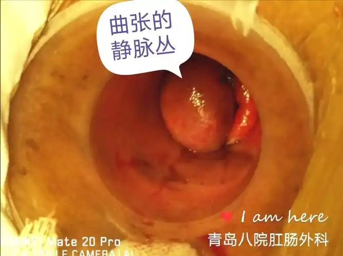 术中取截石位,局麻成功后,置入肛门镜可见齿线周围环周充血静脉丛.