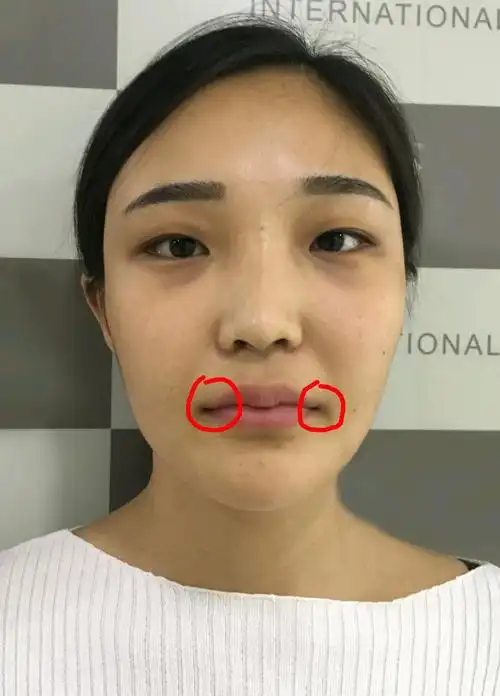 我们平常说的木偶纹是哪里