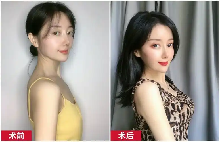 武汉欣悦刘骏做假体隆胸怎么样