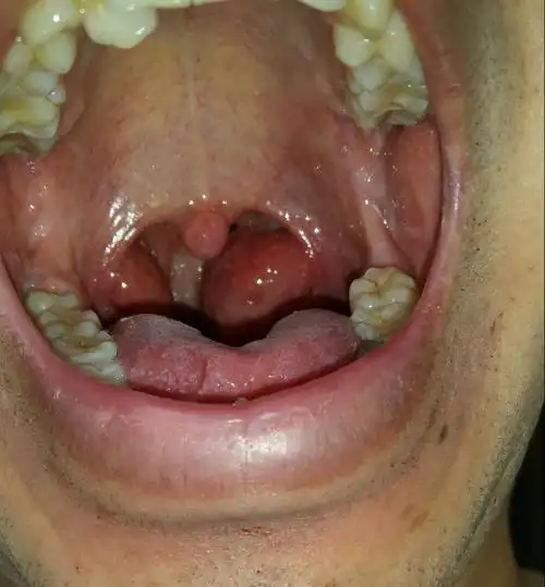 扁桃体三度肿大(腰痛,低热,肾虚的症状),有二十年乙肝病史