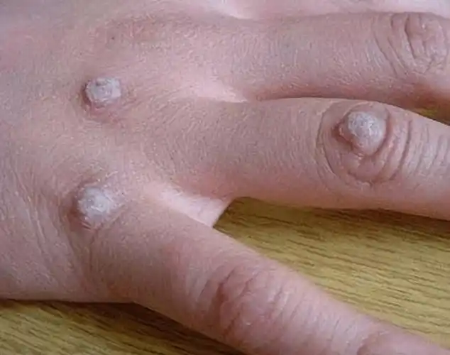 身上长的瘊子到底是什么如何根治