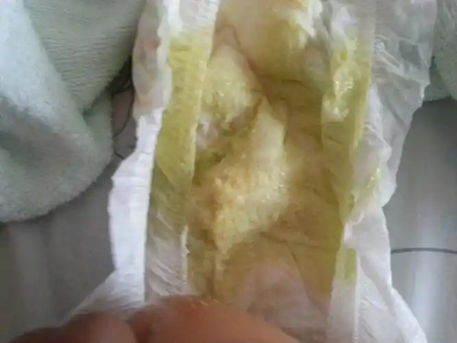 大便颜色浅,几乎不含胆汁,接近白陶土样胆道闭锁葛西术后一年,患儿