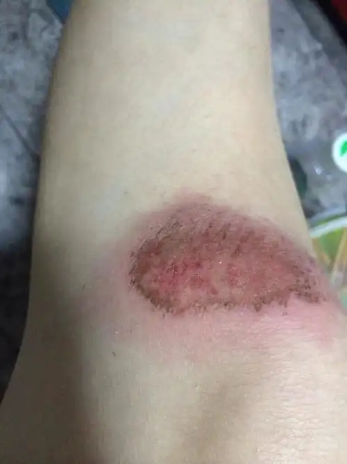 膝盖擦伤大概四五天了 擦伤当时如图一就去药店 店员让我把百多邦消毒