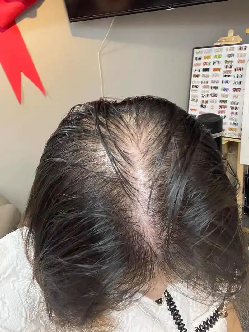 重度秃头"绝杀药"!(上岸版)自用的长发方法不踩雷 - 抖音