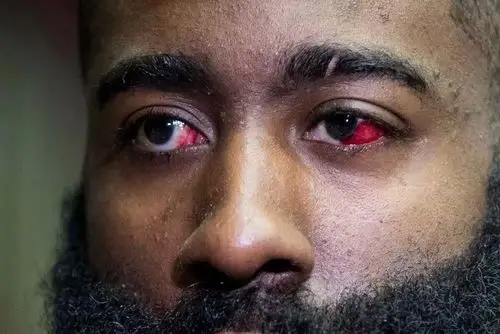 [更新]哈登眼伤蛮严重的