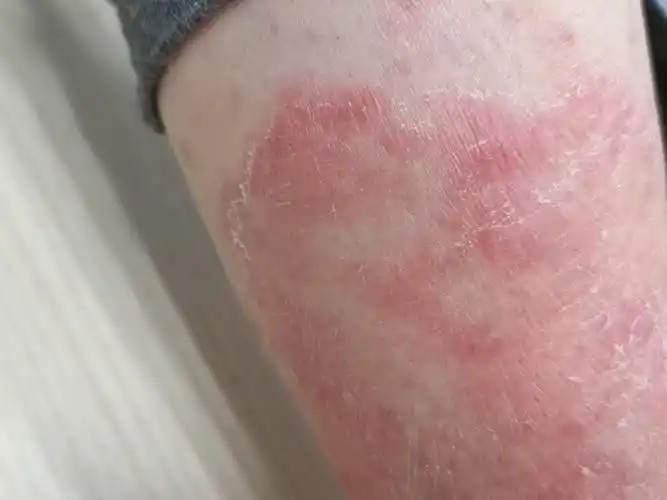 手足癣体癣皮肤癣菌病@著作权归作者所有,未经许